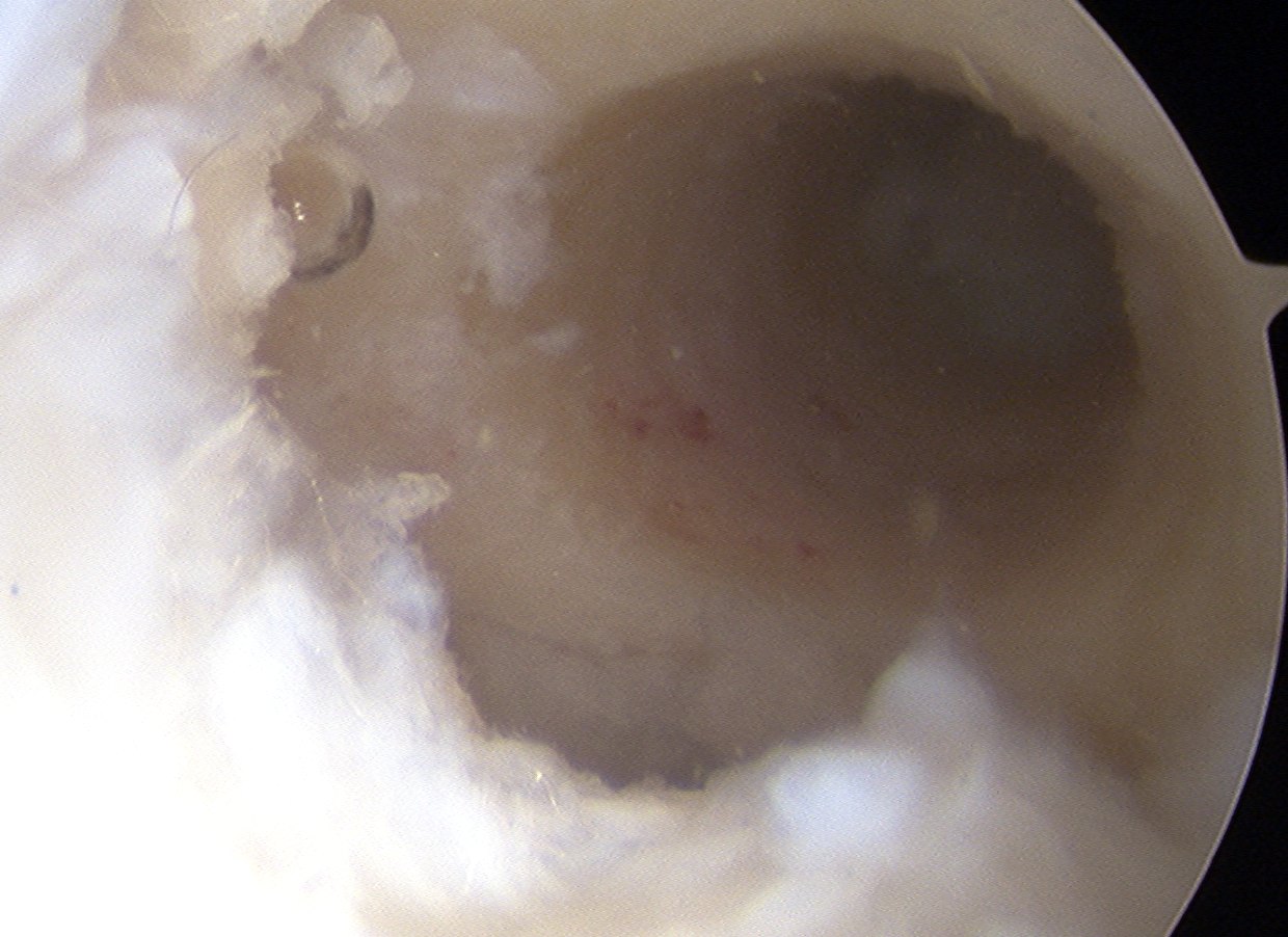 Femoral Tunnel Debrided